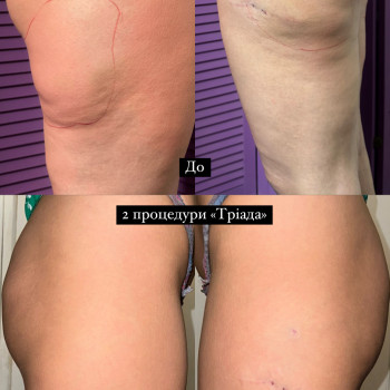 Липолитики
                    Косметолог Виктория Харків