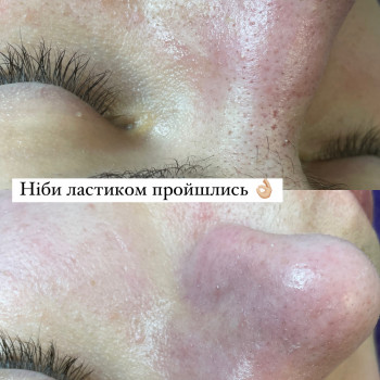 Чистка обличчя
                    Косметолог Виктория Харьков