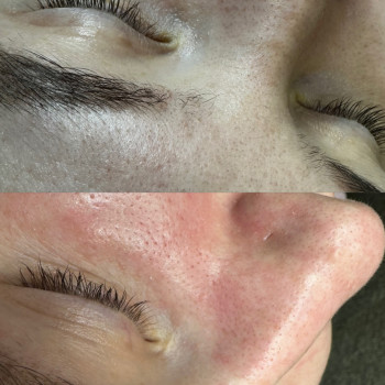 Чистка обличчя
                    Косметолог Виктория Харьков