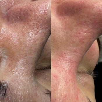 Чистка обличчя
                    Косметолог Виктория Харьков