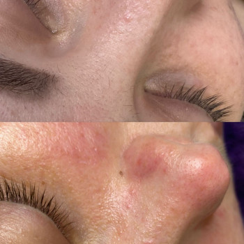 Чистка обличчя
                    Косметолог Виктория Харьков