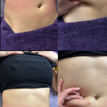 Липолитики
                    Косметолог Виктория Харків