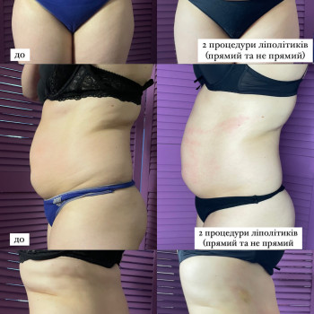 Липолитики
                    Косметолог Виктория Харків