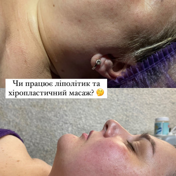 Липолитики
                    Косметолог Виктория Харків