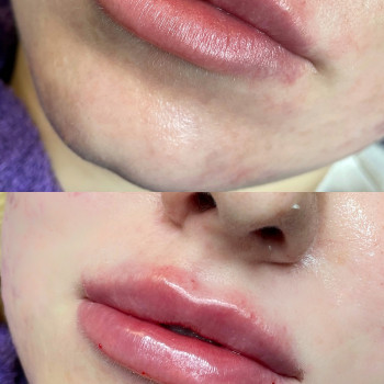 Збільшення губ
                    Косметолог Виктория Харьков