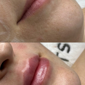 Збільшення губ
                    Косметолог Виктория Харьков