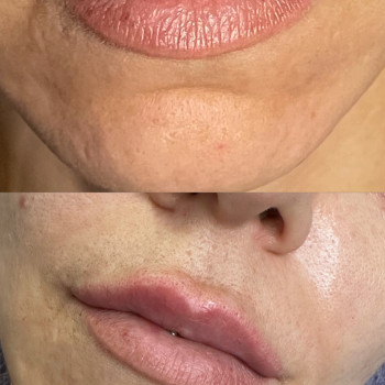 Збільшення губ
                    Косметолог Виктория Харьков