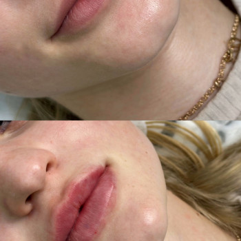 Збільшення губ
                    Косметолог Виктория Харьков