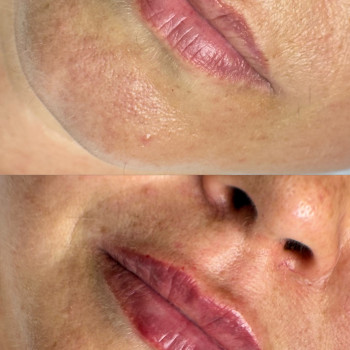 Збільшення губ
                    Косметолог Виктория Харьков