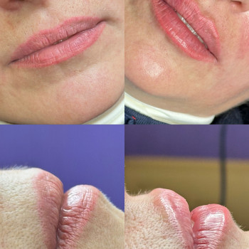 Збільшення губ
                    Косметолог Виктория Харьков