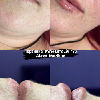 Збільшення губ
                    Косметолог Виктория Харьков