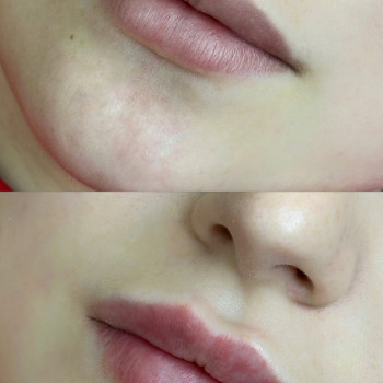 Збільшення губ
                    Косметолог Виктория Харьков