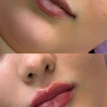 Збільшення губ
                    Косметолог Виктория Харьков