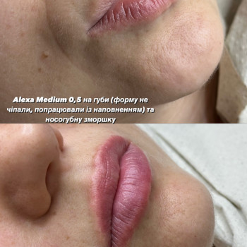 Збільшення губ
                    Косметолог Виктория Харьков