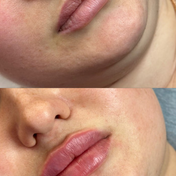 Збільшення губ
                    Косметолог Виктория Харьков