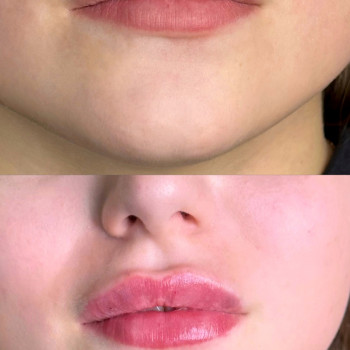 Збільшення губ
                    Косметолог Виктория Харьков