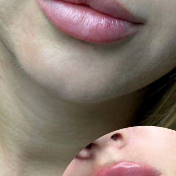 Збільшення губ
                    Косметолог Виктория Харьков