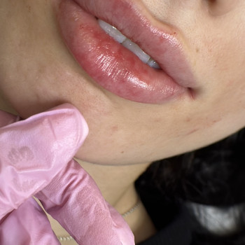 Збільшення губ
                    Косметолог Виктория Харьков