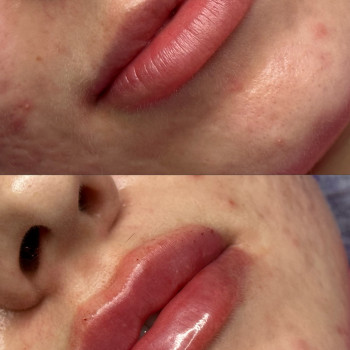 Збільшення губ
                    Косметолог Виктория Харьков
