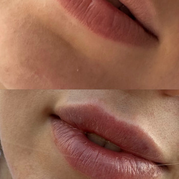 Збільшення губ
                    Косметолог Виктория Харьков