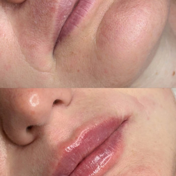 Збільшення губ
                    Косметолог Виктория Харьков