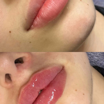 Збільшення губ
                    Косметолог Виктория Харьков