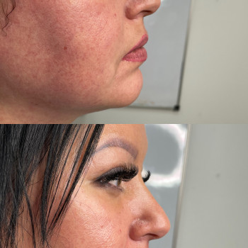 Збільшення губ
                    Косметолог Виктория Харьков