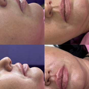 Збільшення губ
                    Косметолог Виктория Харьков