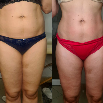 Результат від 8 сеансів антицеллюлітного масажу
 