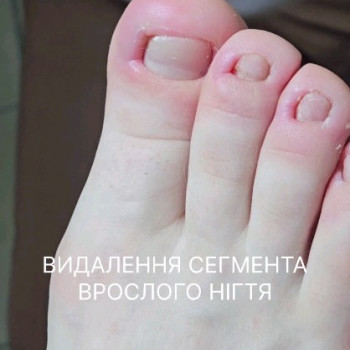 вросший ноготь