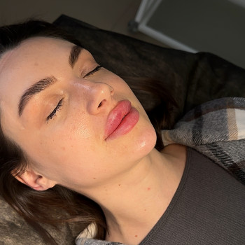 Контурная пластика губ