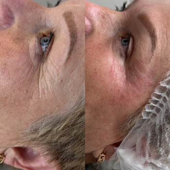 Бланшинг- заполнение мелких морщин. Эффект до 1 года