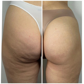 Медовий антицелюлітний масаж + обгортання
                    Масажист Іван Львів