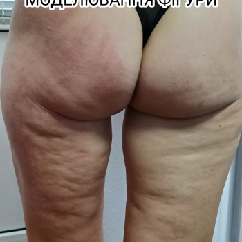 Фото До курсу Антицелюлітний масаж