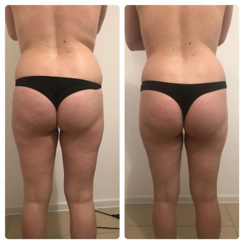 Результат вакуумного массажа банками.