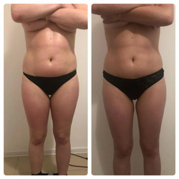 Результат вакуумного массажа банками.