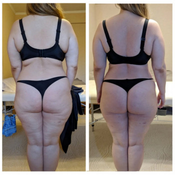 Результат вакуумного массажа банками