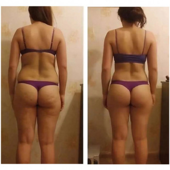 Результат вакуумного массажа банками.