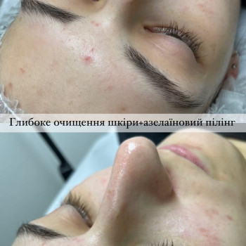 Чистка + пілінг