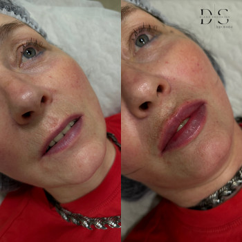 Вікові губки, обожнюю з ними працювати, бо перевтілення неймовірне😍
Препарат: Stylage M 1ml
⏰Час 40х...