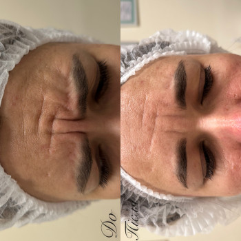 Ботулінотерапія зони:
Лоб+межбрів’я+очі+кролячі зморшки.
Результат на 14 день👌🏻
‼️Далі вже треба про...