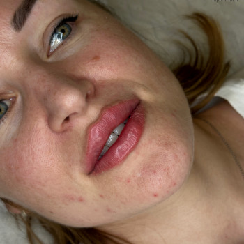 Первинні губки🌺
Препарат: Stylage M 1ml