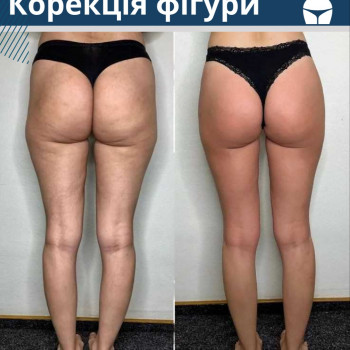 Обгортання маска "Гарячий шоколад"
                    Масажист Іван Львів