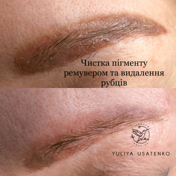 Видалення татуажу ремувером