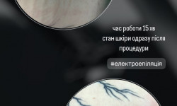 Електро епіляція Мастер депиляции Виктория Запорожье