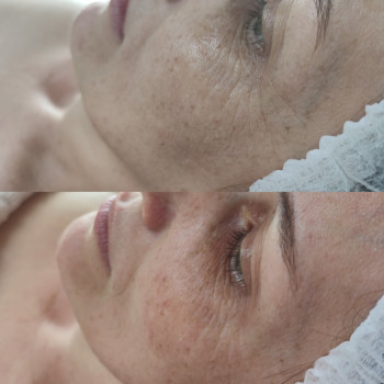 Ферментотерапія