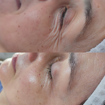 Киснева мезотерапія