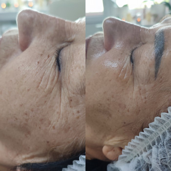 СПА чистка обличчя