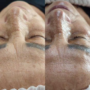 Спа чистка обличчя