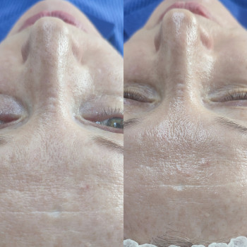 УЗ чистка обличчя